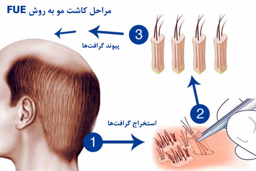 مراحل کاشت مو به روش FUE یا FIT