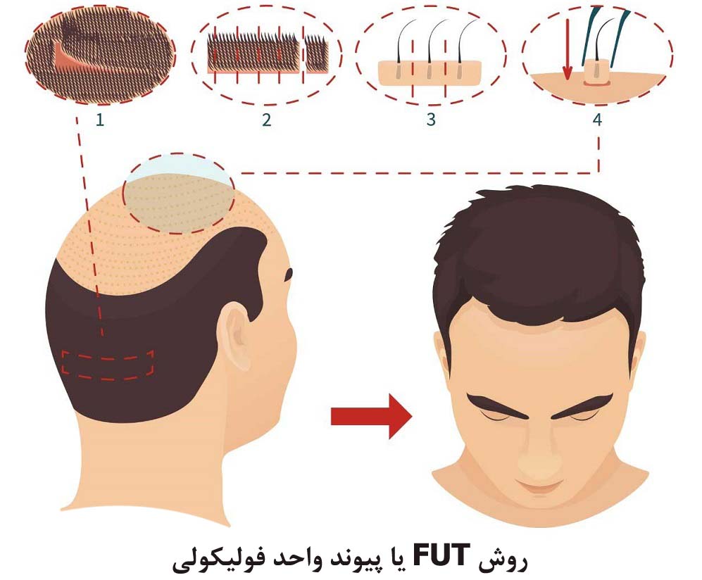 مراحل کاشت مو به روش FUT