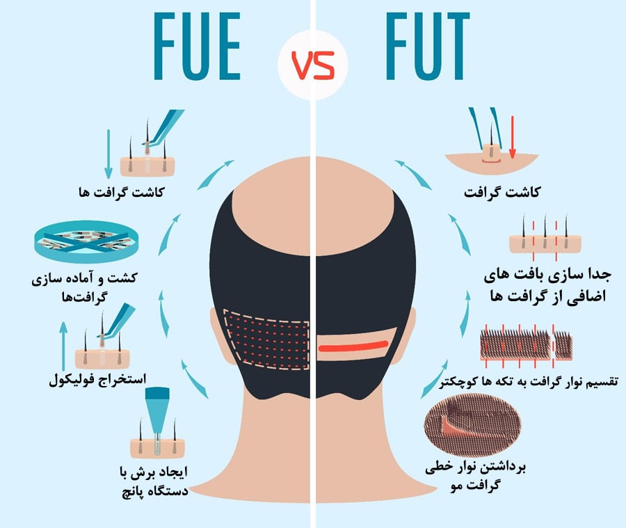 کاشت مو به روش FUT بهتر است یا FUE