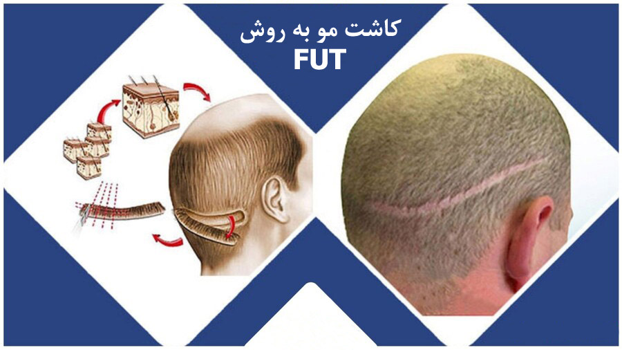 کاشت مو به روش FUT چیست؟