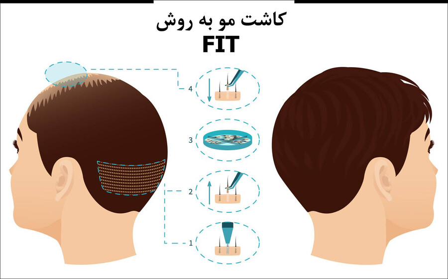 کاشت مو به روش FIT چیست؟