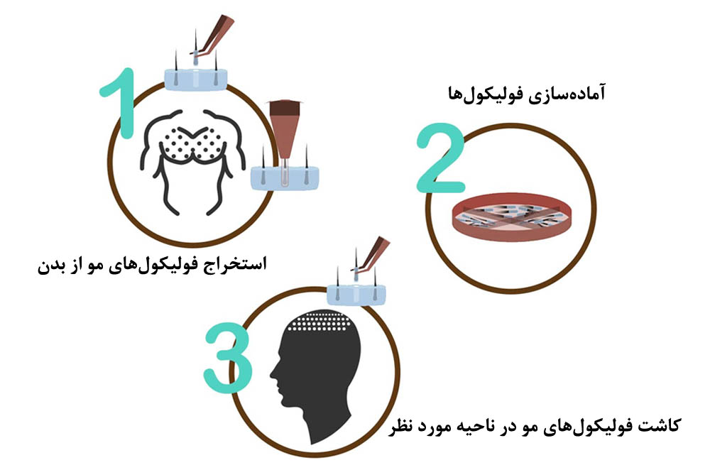 کاشت مو به روش BHT چیست؟