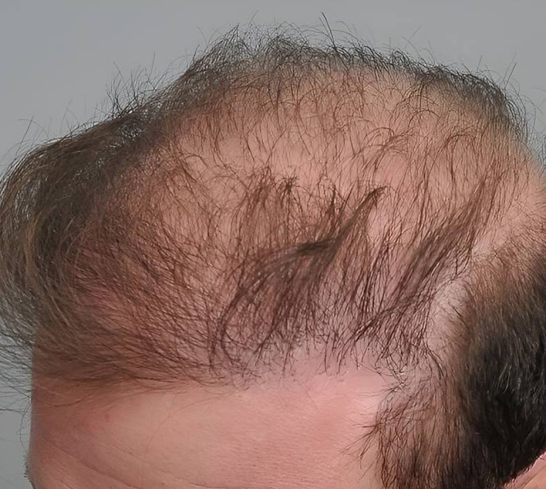 ریزش مو بعد از کاشت مو چه زمانی غیرطبیعی است
